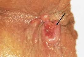 This  anal cancer   had been treated    
