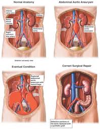 An  abdominal aortic aneurysm 