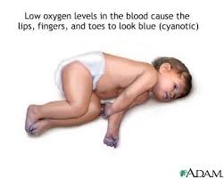  Cyanotic heart disease 