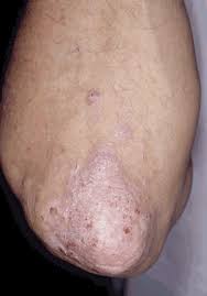 Oral treatment for  Psoriasis 