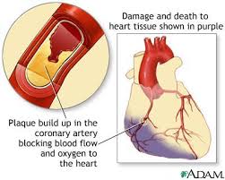 http://medicalimages.allrefer.com/large/acute-mi.jpg