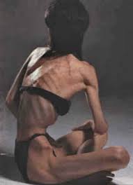 they beat  anorexia     yeah    