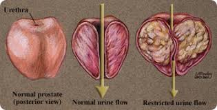 BPH generally does not interfere