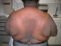 http://bestpractice.bmj.com/best-practice/images/bp/424-2_default.jpg