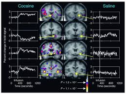  cocaine intoxication 