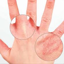 In general,  dry skin  most