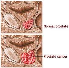 Learning About  Prostate Cancer 