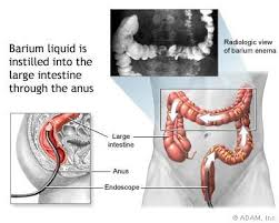 Barium Enema