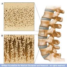 bone density osteoporosis test - via Daymix