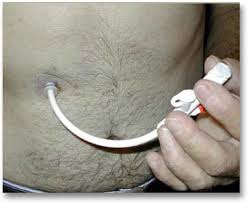 Feeding  tube   Photo credit hncancer