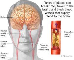  Stroke Related  to  Cocaine Use 