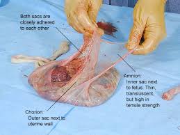 Separation of  Amniotic   and Chorionic    