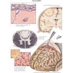 TITLE: Neurosyphilis