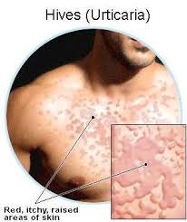 One hallmark of  hives 