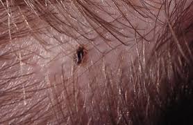 http://www.treehugger.com/head-lice-on-head.jpg