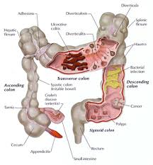 Colon  Diseases 