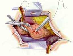  Minimally Invasive Aortic 