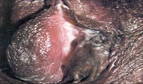 Chlamydia - via Daymix