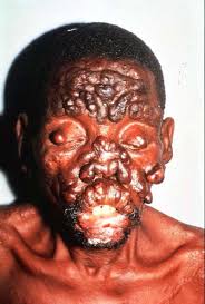from getting Leprosy then - via Daymix