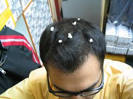  Dandruff  is in fact a