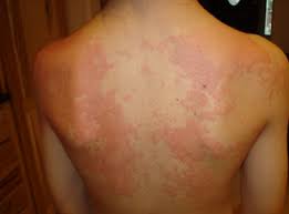  Hives 
