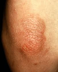 http://www.skincareguide.ca/images/glossary/acrodermatitis_enteropathica.jpg