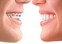 Clear Braces vs. Metal Braces