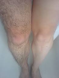 Hair Removal Laser Treatment