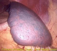 Splenomegaly 