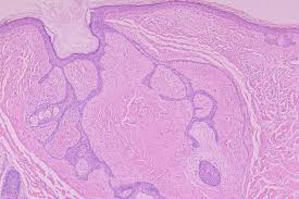 http://dermatology.cdlib.org/DOJvol3num2/path/fig5.jpeg