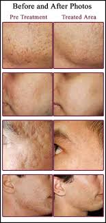 laser hair removal cost,