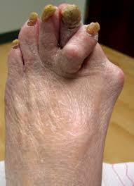 A bunion and hammertoe probably
