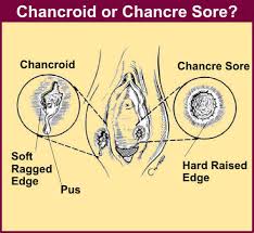  Chancroid  or Chancre Sore?