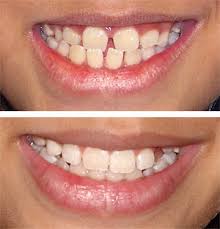  Teeth 