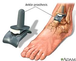  Ankle replacement 