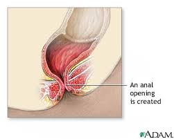 Imperforate anus repair -