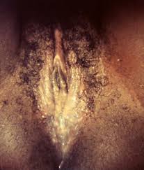  Genital herpes  on the