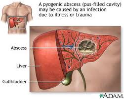 A liver  abscess  can develop