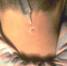A  furuncle  at the nape of the