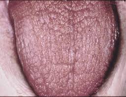 http://www.hopkins-arthritis.org/images/xerostomia.jpg