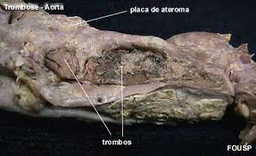 http://www.fo.usp.br/lido/patoartegeral/images/trombose3.jpg