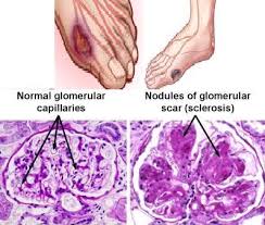 http://www.101healthsolution.com/images/diabetes-mellitus.JPG