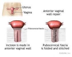  Anterior vaginal wall repair 