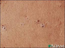 Blackheads, or open  comedones ,