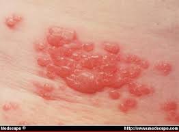 AIDSmeds.com - Herpes Zoster Virus (shingles) : What are the symptoms?