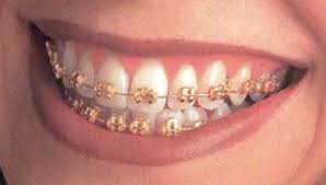 Gold Plated Braces