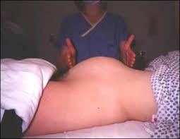 Pelvic  mass .