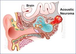  Acoustic neuroma  is one of