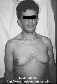 http://scienceblogs.com/corpuscallosum/images/gynecomastia.jpg