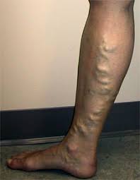 A swollen  vein  can often be